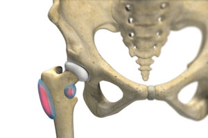 Hip Bursitis, Conditions Treated