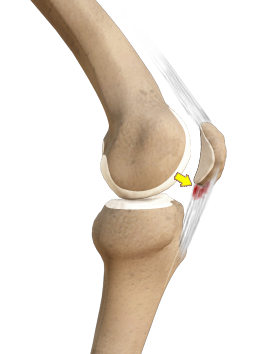 Patellar Tendinitis 